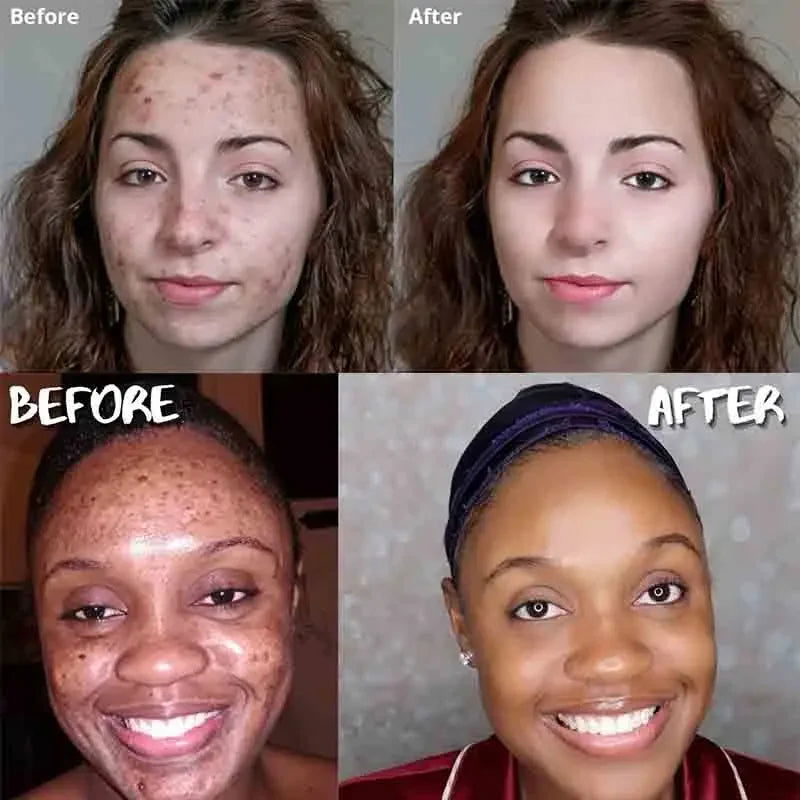 Turmeric Soap Face Cleansing Anti Acne - Woman`s Clothing